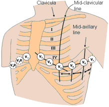 Electrode placement on the chest